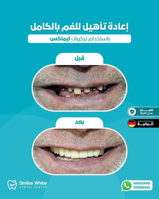 Before and after full-mouth rehabilitation result at Smilee White Dental Center